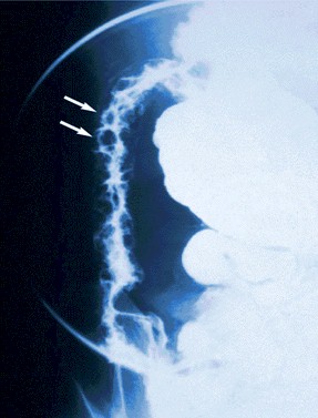 enfermedad_crohn_colitis_ulcerosa/crohn_radiografia_abdominal_empredrado