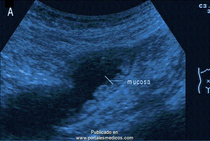 enfermedad_crohn_colitis_ulcerosa/ecografia_abdominal_colitis_ulcerativa enfermedad_crohn_colitis_ulcerosa/ecografia_abdominal_colitis_ulcerativa