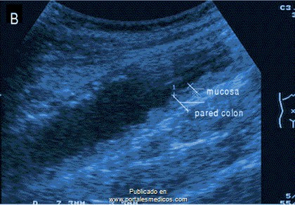 enfermedad_crohn_colitis_ulcerosa/ecografia_abdominal_enfermedad_crohn