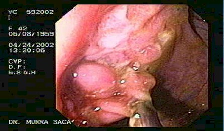 enfermedad_crohn_colitis_ulcerosa/endoscopia_biopsia_intestinal_crohn