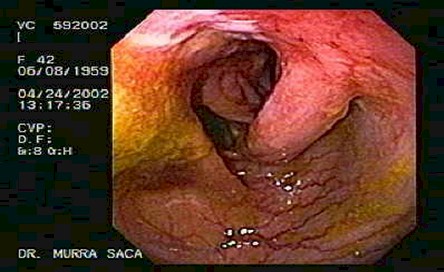 enfermedad_crohn_colitis_ulcerosa/estenosis_colon_transverso_enfermedad_crohn