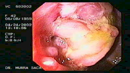 enfermedad_crohn_colitis_ulcerosa/estenosis_nodular_ulcerada_crohn