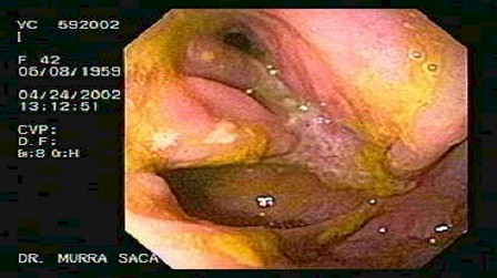 enfermedad_crohn_colitis_ulcerosa/estenosis_ulcera_colon_transverso_crohn