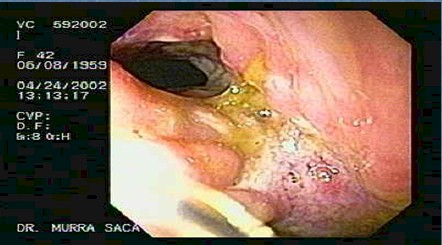 enfermedad_crohn_colitis_ulcerosa/estenosis_ulceracion_colon_transverso_crohn