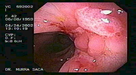 enfermedad_crohn_colitis_ulcerosa/estenosis_ulceras_recto_sigmoides_crohn