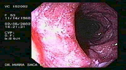 enfermedad_crohn_colitis_ulcerosa/mucosa_friable_colitis_ulcerativa