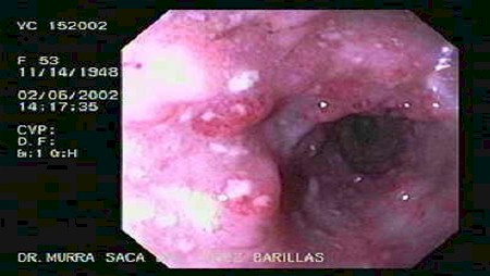 enfermedad_crohn_colitis_ulcerosa/mucosa_nodulos_colitis_ulcerativa