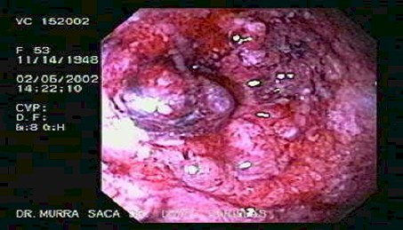enfermedad_crohn_colitis_ulcerosa/necrosis_mucosa_colitis_ulcerativa enfermedad_crohn_colitis_ulcerosa/necrosis_mucosa_colitis_ulcerativa