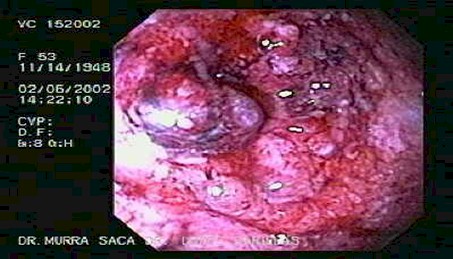 enfermedad_crohn_colitis_ulcerosa/necrosis_mucosa_colitis_ulcerativa