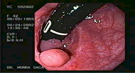 Enfermedad de crohn esteroides