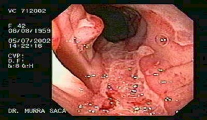 enfermedad_crohn_colitis_ulcerosa/ulceraciones_serpinginosas_sigmoides_crohn