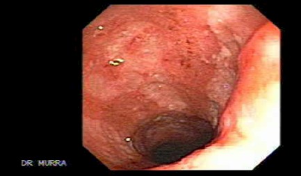 enfermedad_crohn_colitis_ulcerosa/ulceras-colon_izquierdo_colitis_ulcerativa