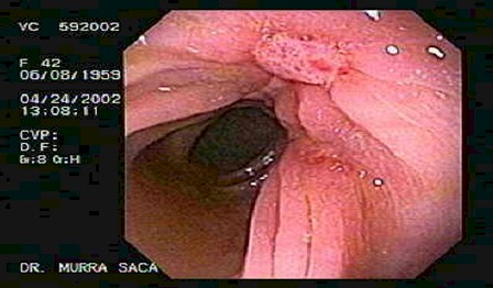 enfermedad_crohn_colitis_ulcerosa/ulceras_recto_sigmoides_crohn