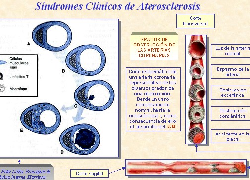 marcadores_cardiacos/sindromes_clinicos_aterosclerosis