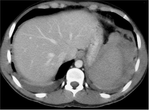 rotura_espontanea_bazo/rotura_esplenica_hemoperitoneo