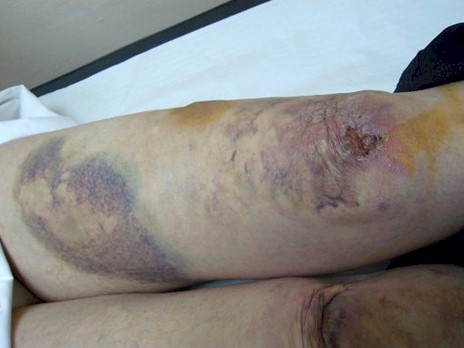 sindrome_ehlers_danlos/dehiscencia_heridas_hematoma_SED