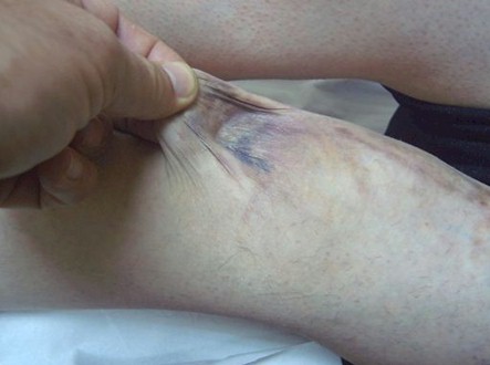 sindrome_ehlers_danlos/hematomas_extensos_ehlers_danlos