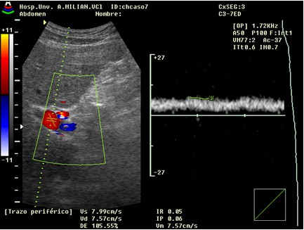 sindrome_hepatorrenal/ecografia_abdominal_flujo_porta sindrome_hepatorrenal/ecografia_abdominal_flujo_porta