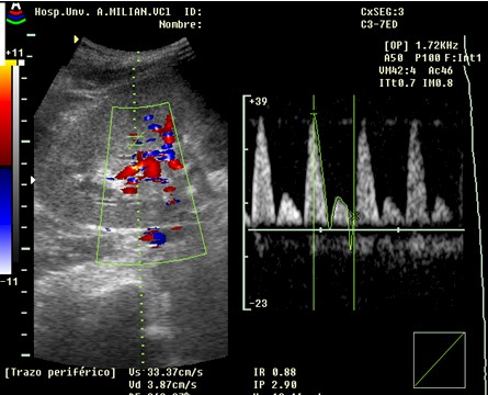 sindrome_hepatorrenal/rinon_ecografia_abdominal_renal sindrome_hepatorrenal/rinon_ecografia_abdominal_renal