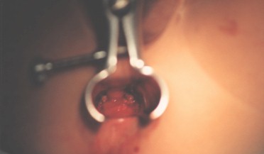 tecnica_extirpacion_polipo_rectal/cese_sangrado_pediculo_residual tecnica_extirpacion_polipo_rectal/cese_sangrado_pediculo_residual