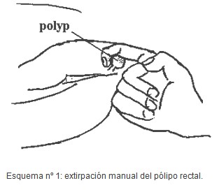 tecnica_extirpacion_polipo_rectal/polipectomia_rectal_digital