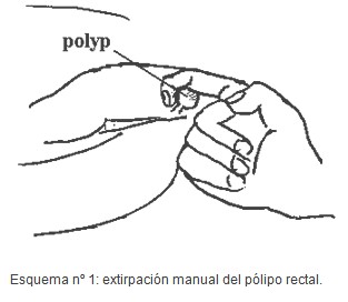 tecnica_extirpacion_polipo_rectal/polipectomia_rectal_digital tecnica_extirpacion_polipo_rectal/polipectomia_rectal_digital