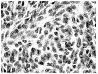 tumores_celulas_granulosa/tumor_granulosa_anatomia_patologica tumores_celulas_granulosa/tumor_granulosa_anatomia_patologica