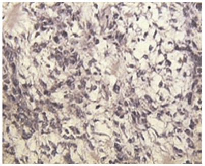 tumores_celulas_granulosa/tumor_granulosa_granos_cafe_microscopio