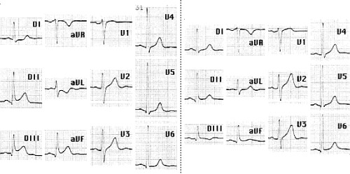 Angina_prinzmetal Angina_prinzmetal