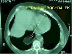 hernia_Bochdalek_TAC1 hernia_Bochdalek_TAC1