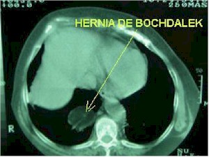 hernia_Bochdalek_TAC1