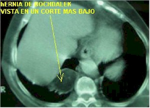 hernia_Bochdalek_TAC2 hernia_Bochdalek_TAC2