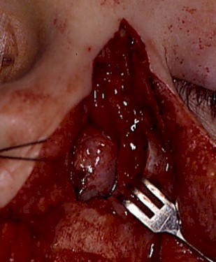 abordaje_transmaxilonasal2 abordaje_transmaxilonasal2