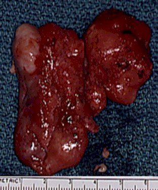 abordaje_transmaxilonasal_anj abordaje_transmaxilonasal_anj