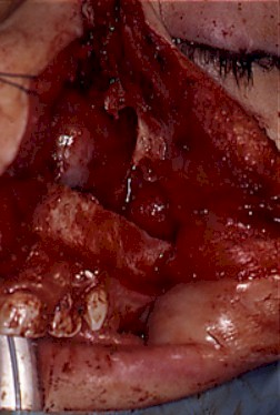 abordaje_transmaxilonasal_maxilotomia abordaje_transmaxilonasal_maxilotomia