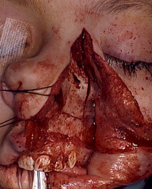 abordaje_transmaxilonasal_rinotomia_osteostomia abordaje_transmaxilonasal_rinotomia_osteostomia