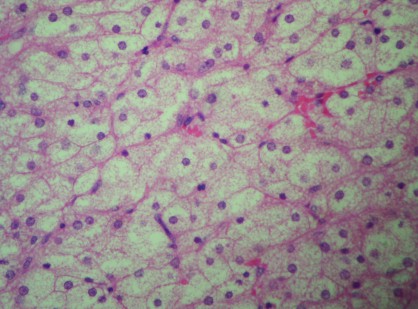 adenoma_adrenal