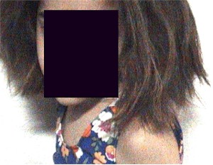 alopecia1 alopecia1