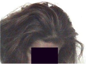 alopecia2 alopecia2