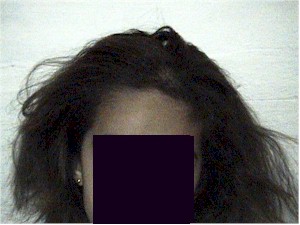 alopecia3 alopecia3