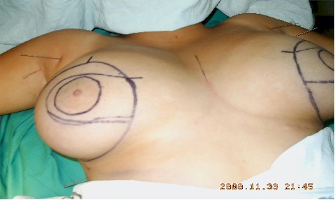 analgesia_acupuntural_cirugia_mama analgesia_acupuntural_cirugia_mama