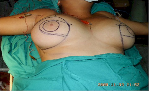 analgesia_acupuntural_cirugia_mama2 analgesia_acupuntural_cirugia_mama2
