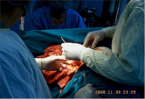 analgesia_acupuntural_cirugia_mama4 analgesia_acupuntural_cirugia_mama4