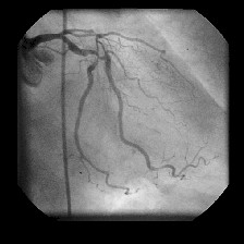 angioplastia_transluminal_percutanea1