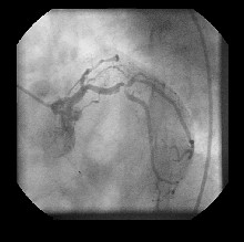 angioplastia_transluminal_percutanea2 angioplastia_transluminal_percutanea2