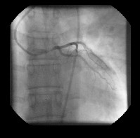 angioplastia_transluminal_percutanea3