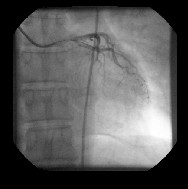 angioplastia_transluminal_percutanea4