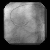 angioplastia_transluminal_percutanea5