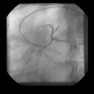 angioplastia_transluminal_percutanea6 angioplastia_transluminal_percutanea6