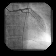 angioplastia_transluminal_percutanea7 angioplastia_transluminal_percutanea7